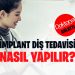 İmplant Diş Tedavisi Nasıl Yapılır?